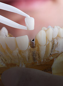 Model of implant supported dental crown