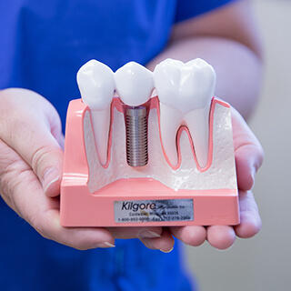 Model of implant supported denture